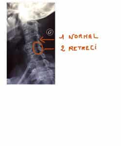 colonne-vertebrale (2)